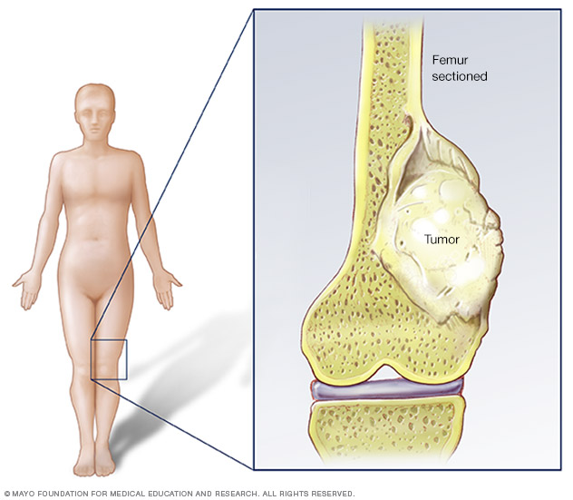 Bone Cancer - ACCO