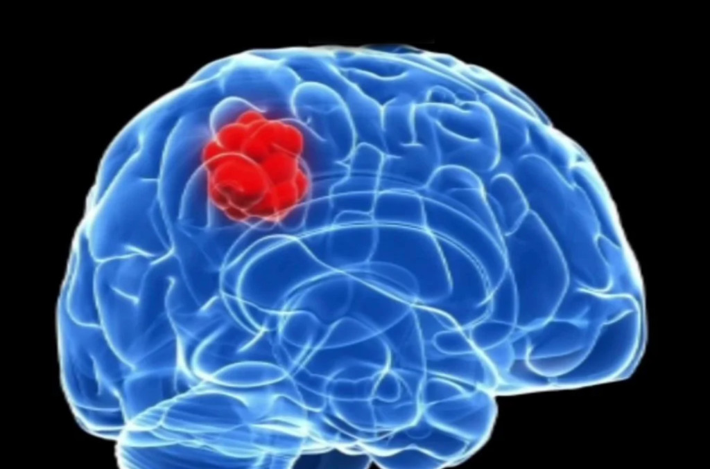 Brain tumour diagnosis The Brain Tumour Charity