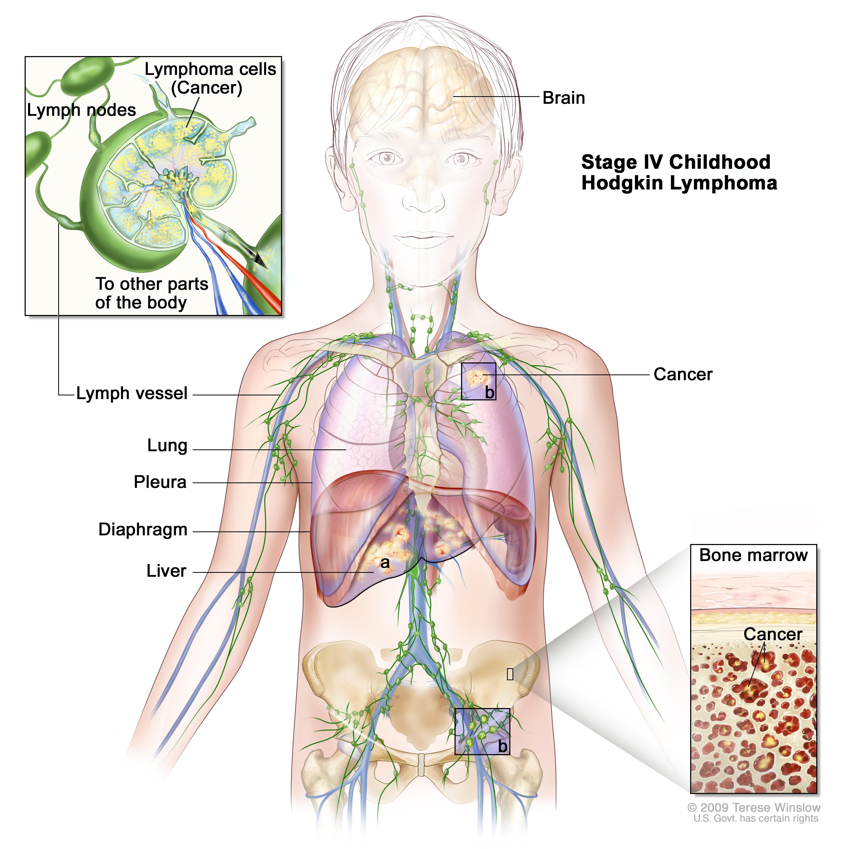 Hodgkin cancer lymph nodes