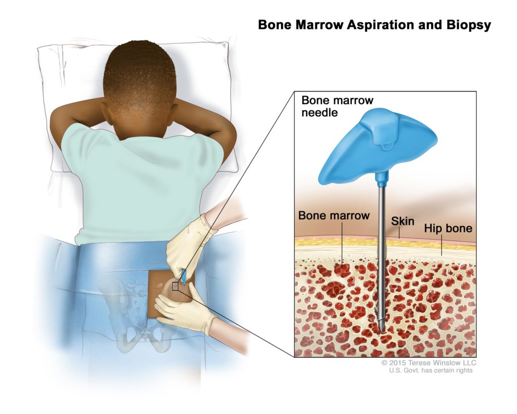 How is Childhood Hodgkin Lymphoma Diagnosed