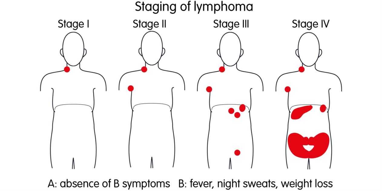 Lymphoma-Types-Causes-Symptoms-Diagnosis-Allopathic and Homeopathic Treatment-Dr. Qaisar Ahmed