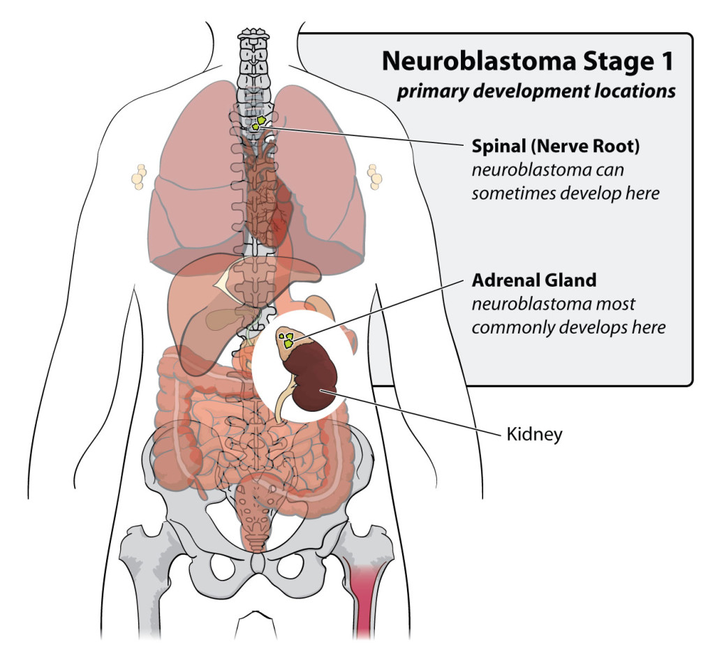 neuroblastoma-stage-1