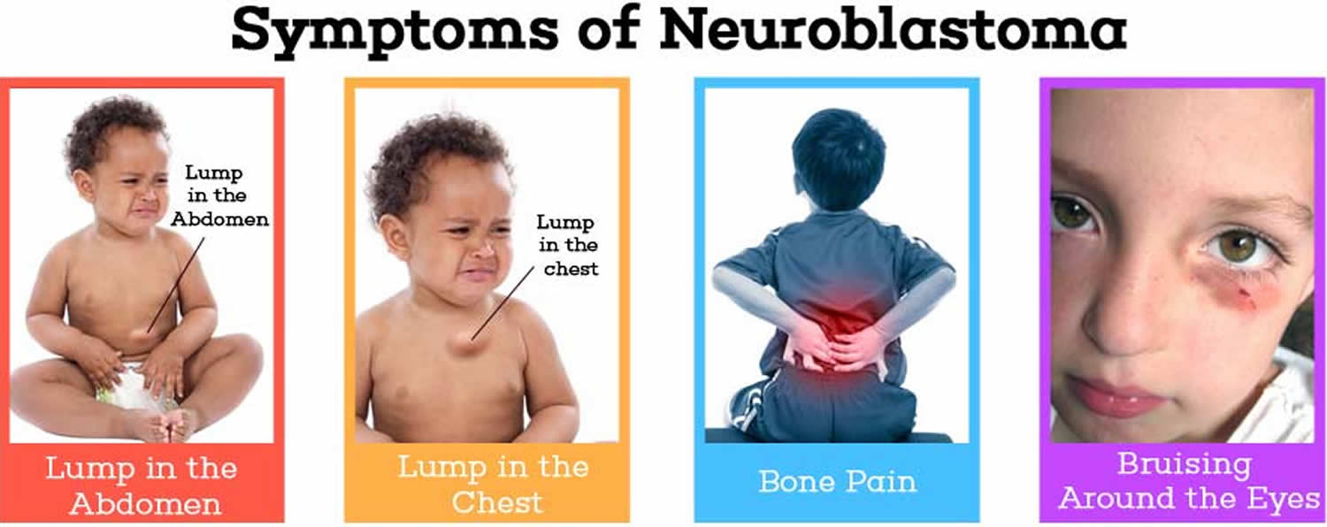 Neuroblastoma Childhood Cancer Signs And Symptoms Acco