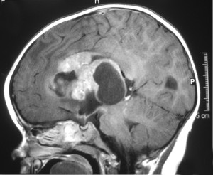 Why do some children develop brain tumors