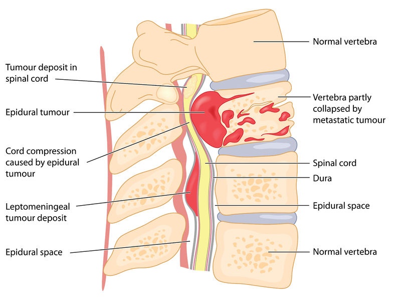 child Spinal Cord cancer