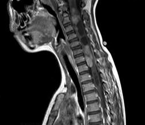 Spinal Cord Tumors in Children