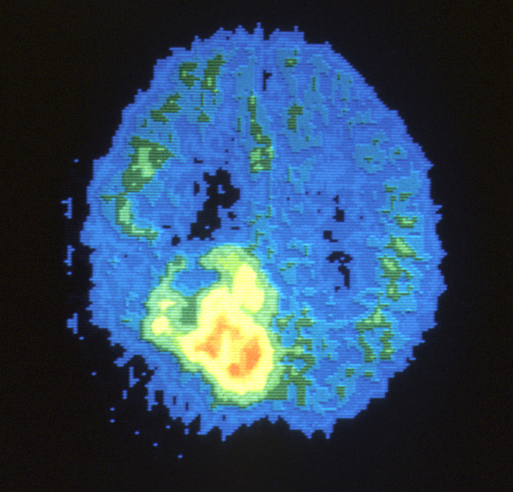 Potential Treatment Options for Childhood Brain Tumors