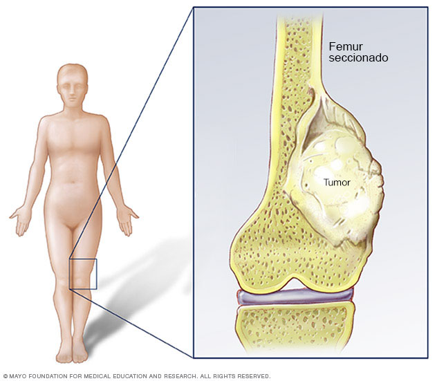 Osteosarcoma es un tipo de cáncer óseo que comienza en las células que forman el hueso. Osteosarcoma ocurre más comúnmente en los huesos largos de brazos y piernas.