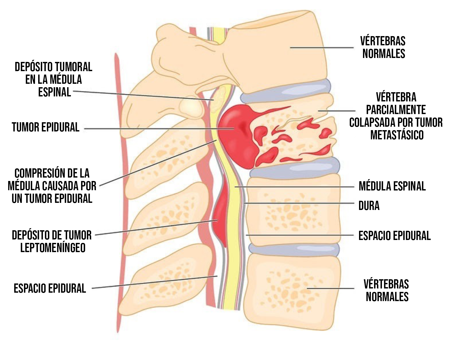 child Spinal Cord cancer